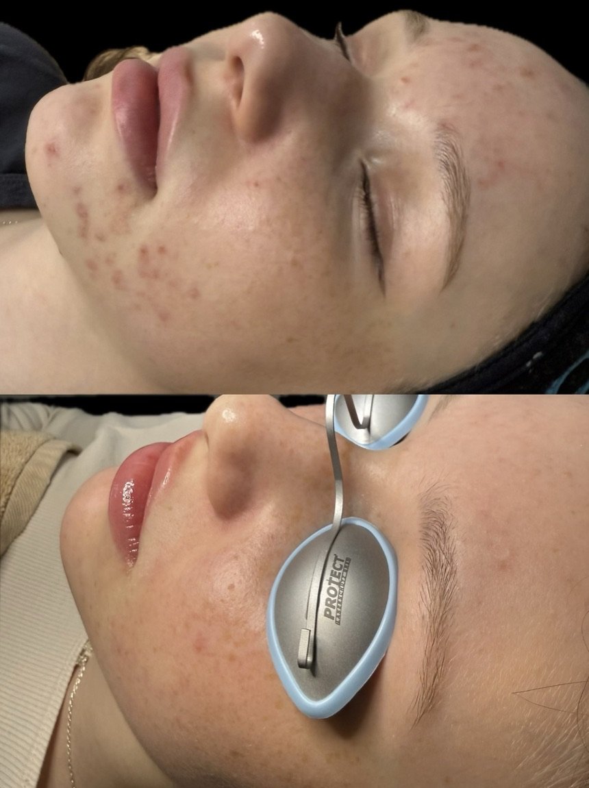 Before and after acne treatment for active breakouts at GetSkin Medical Spa, Hallandale Beach FL