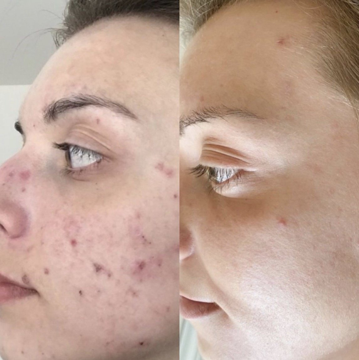Before and after acne treatment for breakouts at GetSkin Medical Spa, Hallandale Beach FL