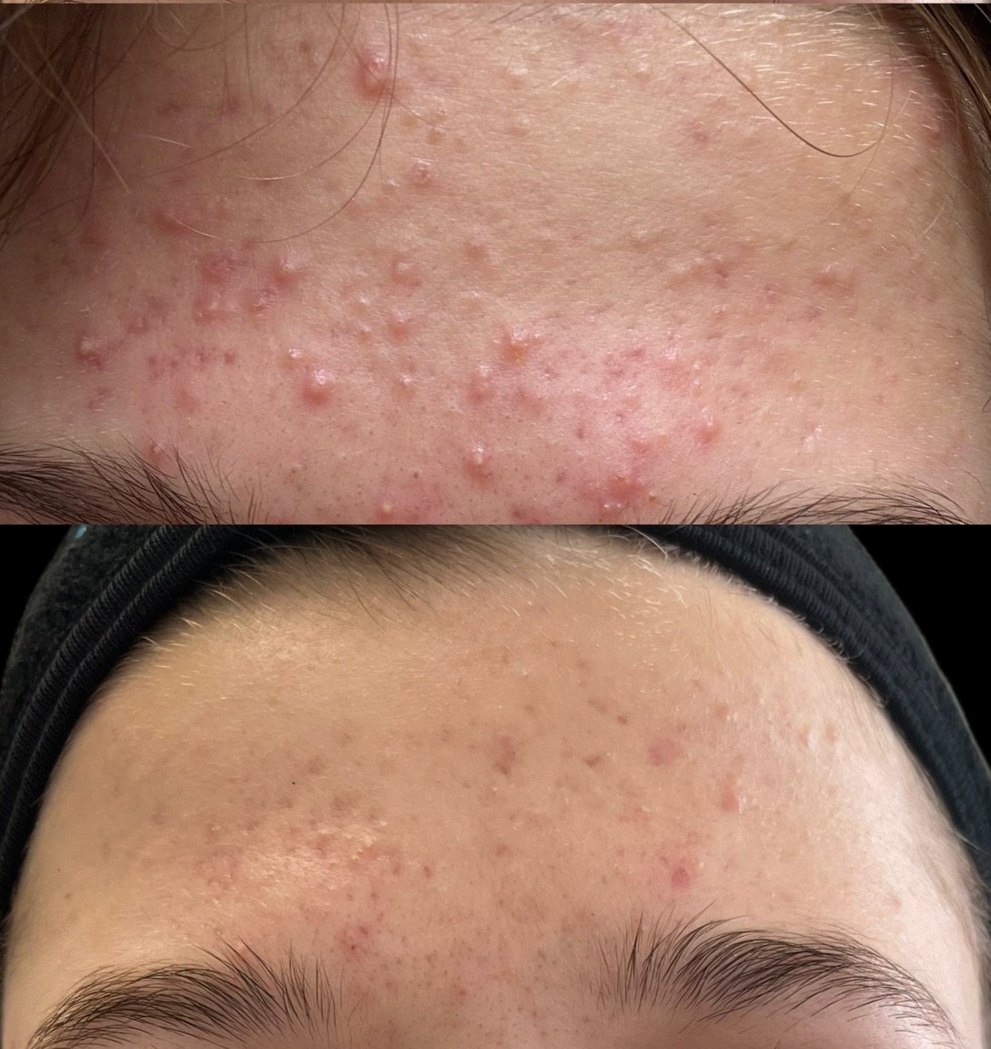 Before and after acne treatment for forehead acne at GetSkin Medical Spa, Hallandale Beach FL