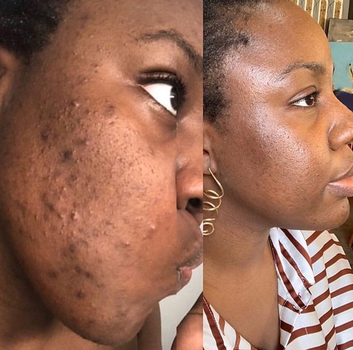 Before and after acne treatment for post-acne marks and scarring at GetSkin Medical Spa, Hallandale Beach FL