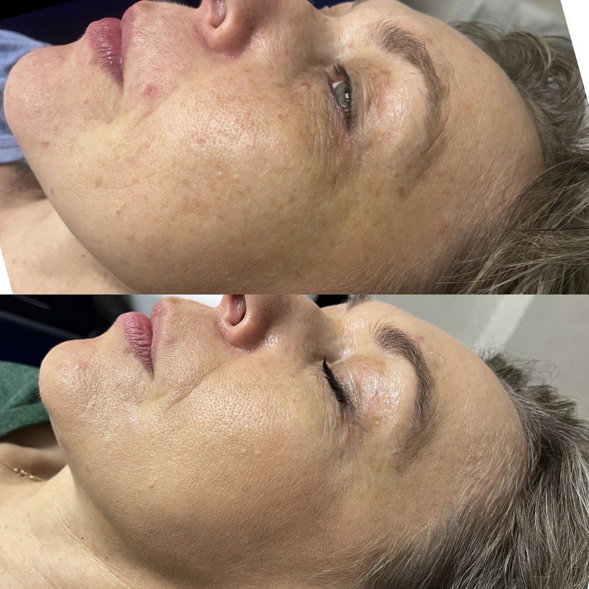 Before and after acne treatment for skin texture at GetSkin Medical Spa, Hallandale Beach FL