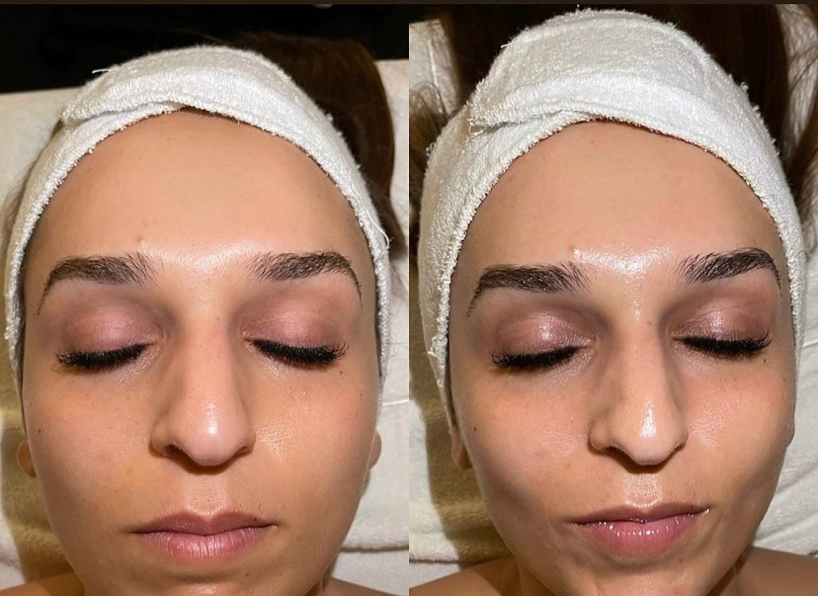 Before and after Biologique Recherche facial for skin radiance at GetSkin Medical Spa, Hallandale Beach FL
