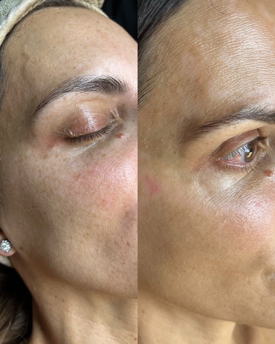 Before and after chemical peel for dark spots and pigmentation at GetSkin Medical Spa, Hallandale Beach FL