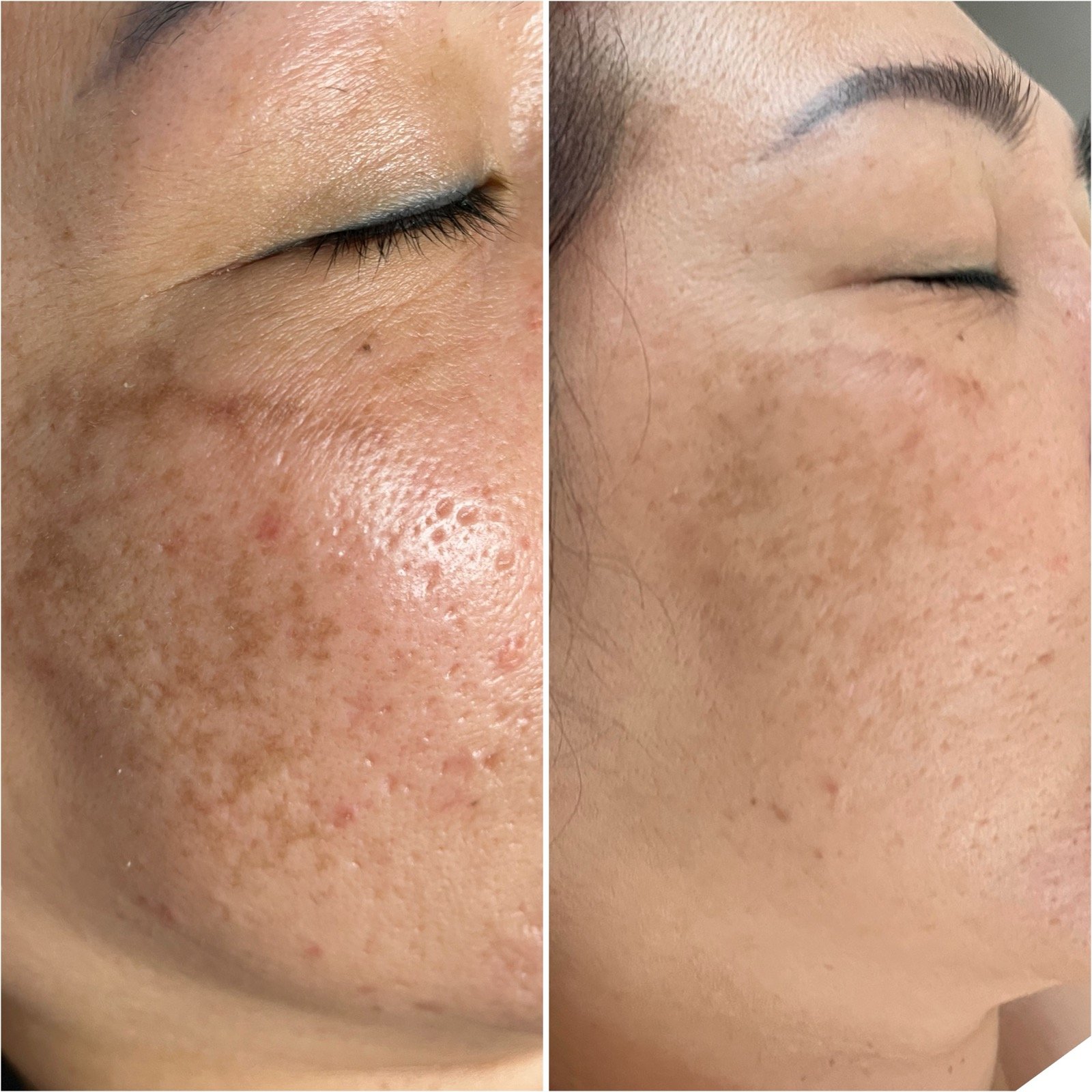 Before and after chemical peel and Glacial Skin for pigmentation at GetSkin Medical Spa, Hallandale Beach FL