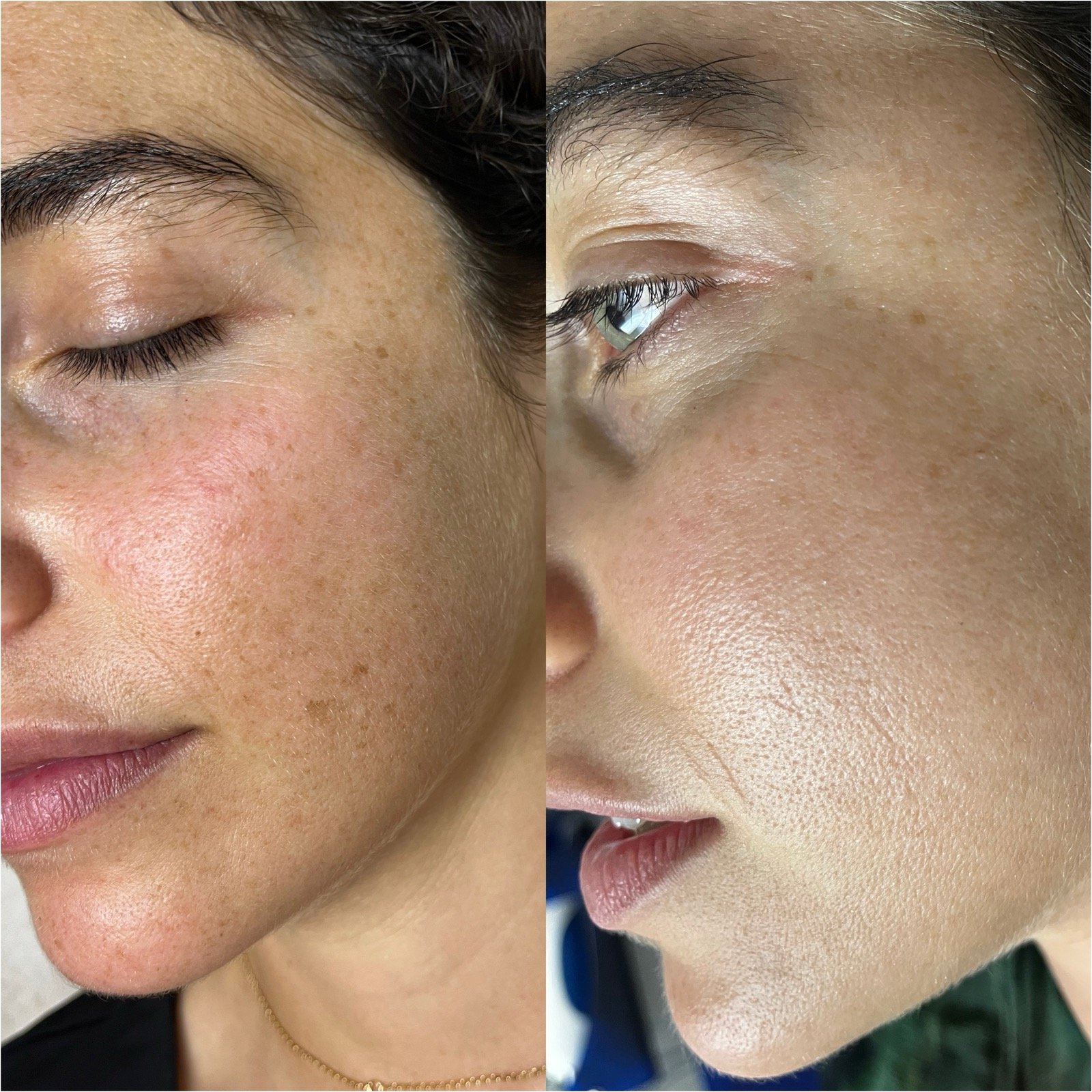 Before and after chemical peel and HydraFacial for pigment removal at GetSkin Medical Spa, Hallandale Beach FL