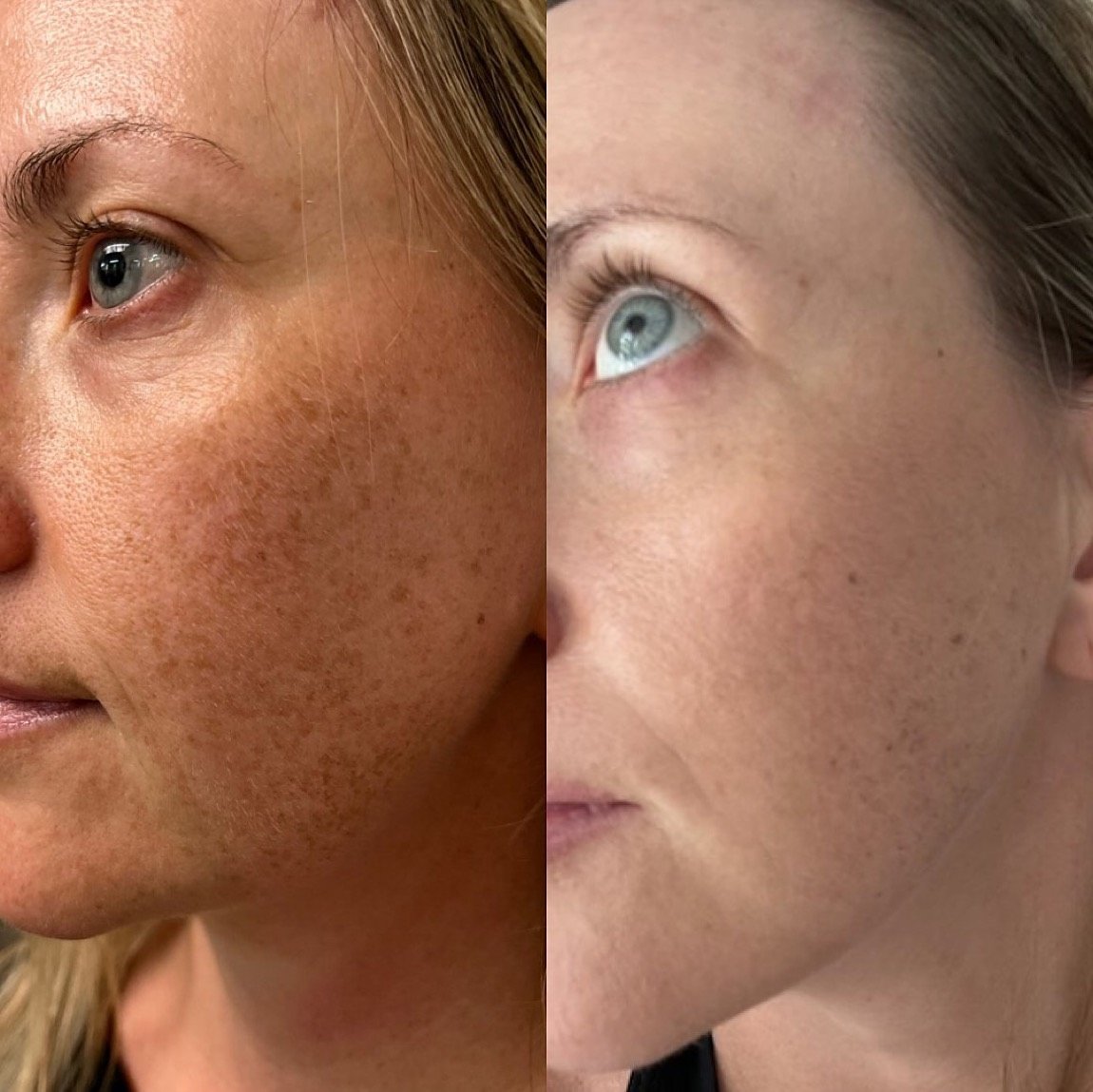Before and after chemical peel for sun spots and pigment at GetSkin Medical Spa, Hallandale Beach FL