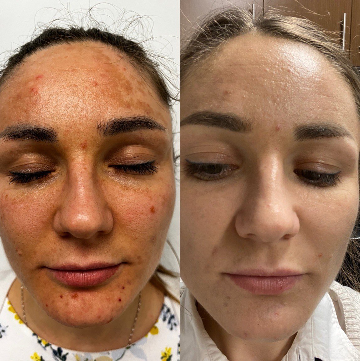 Before and after Clear + Brilliant for facial redness and even tone at GetSkin Medical Spa, Hallandale Beach FL
