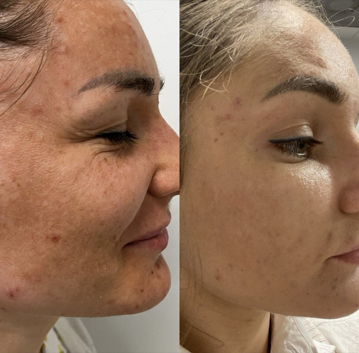 Before and after Clear + Brilliant for pores and radiance at GetSkin Medical Spa, Hallandale Beach FL
