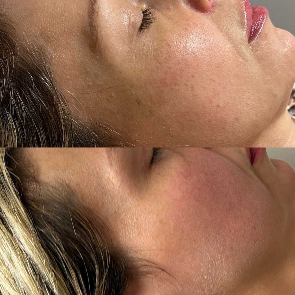 Before and after Clear + Brilliant for skin texture and clarity at GetSkin Medical Spa, Hallandale Beach FL