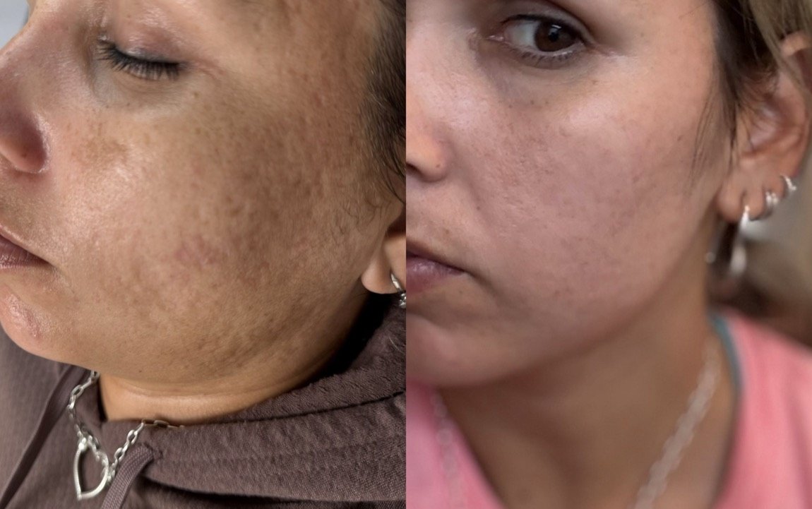 Before and after Clear + Brilliant for skin texture and tone at GetSkin Medical Spa, Hallandale Beach FL