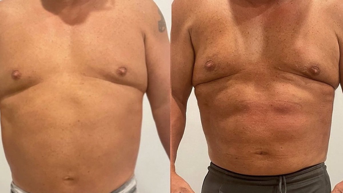 Before and after EvolveX body contouring at GetSkin Medical Spa, Hallandale Beach FL