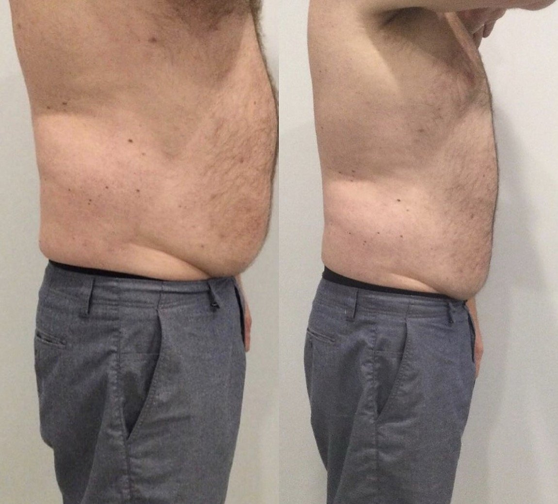 Before and after EvolveX for body and skin tightening at GetSkin Medical Spa, Hallandale Beach FL