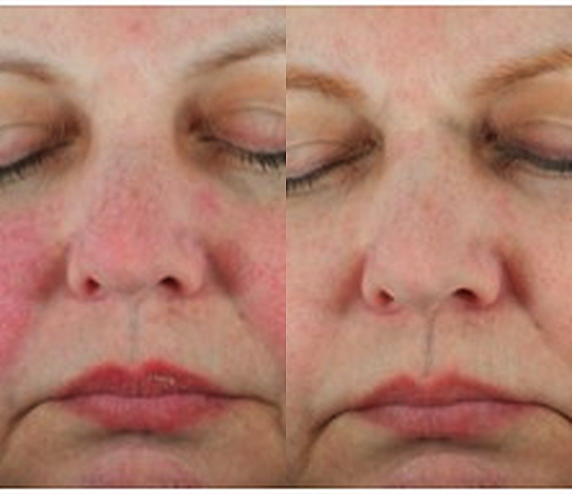 Before and after Glacial Skin for facial redness
