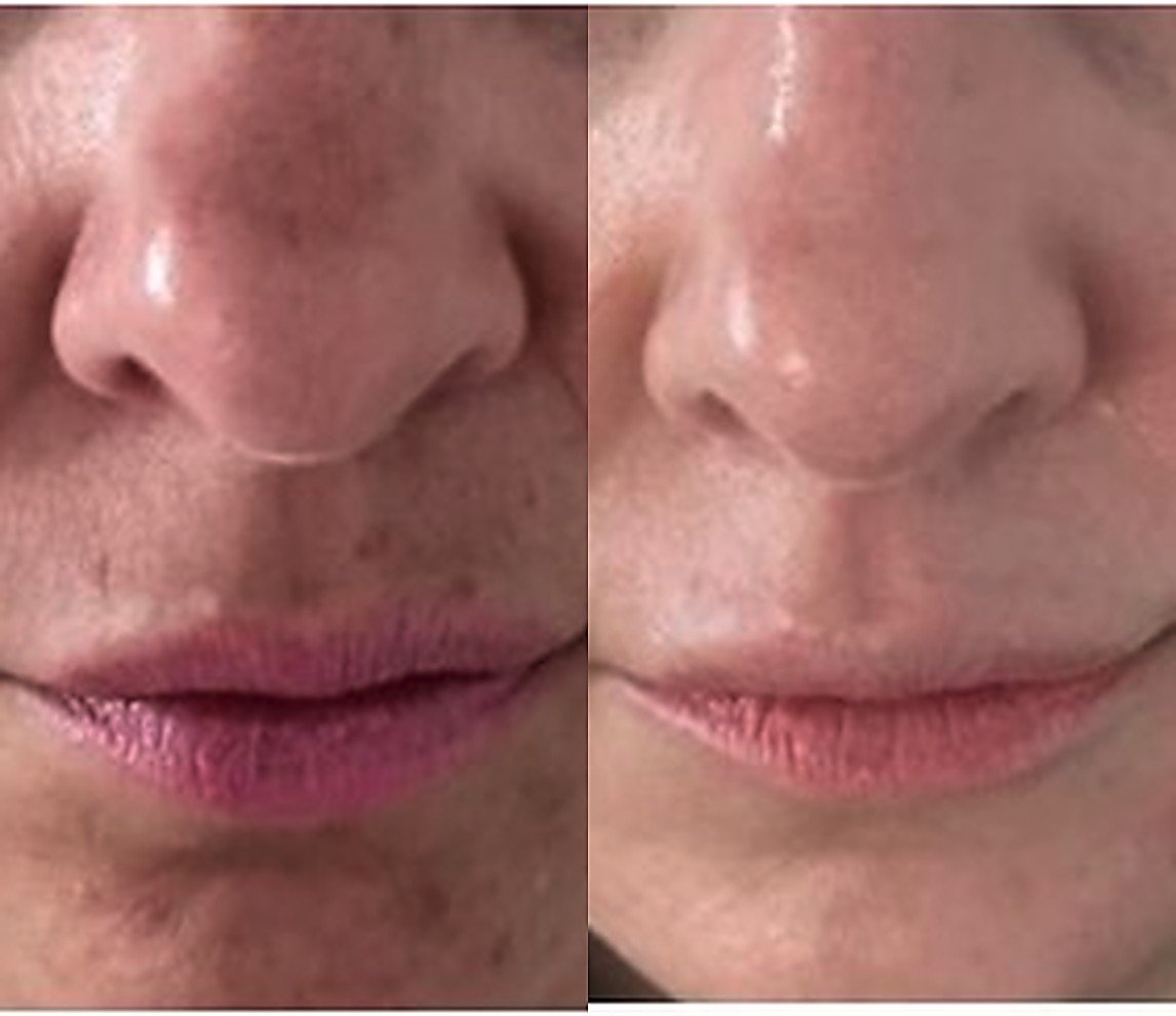 Before and after Glacial Skin for pigmentation and texture