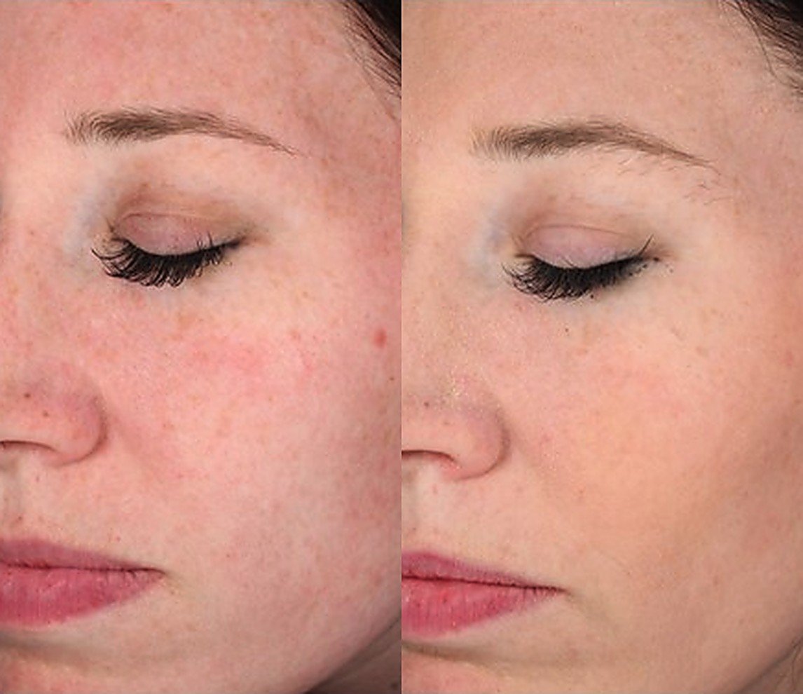 Before and after Glacial Skin for sun damage
