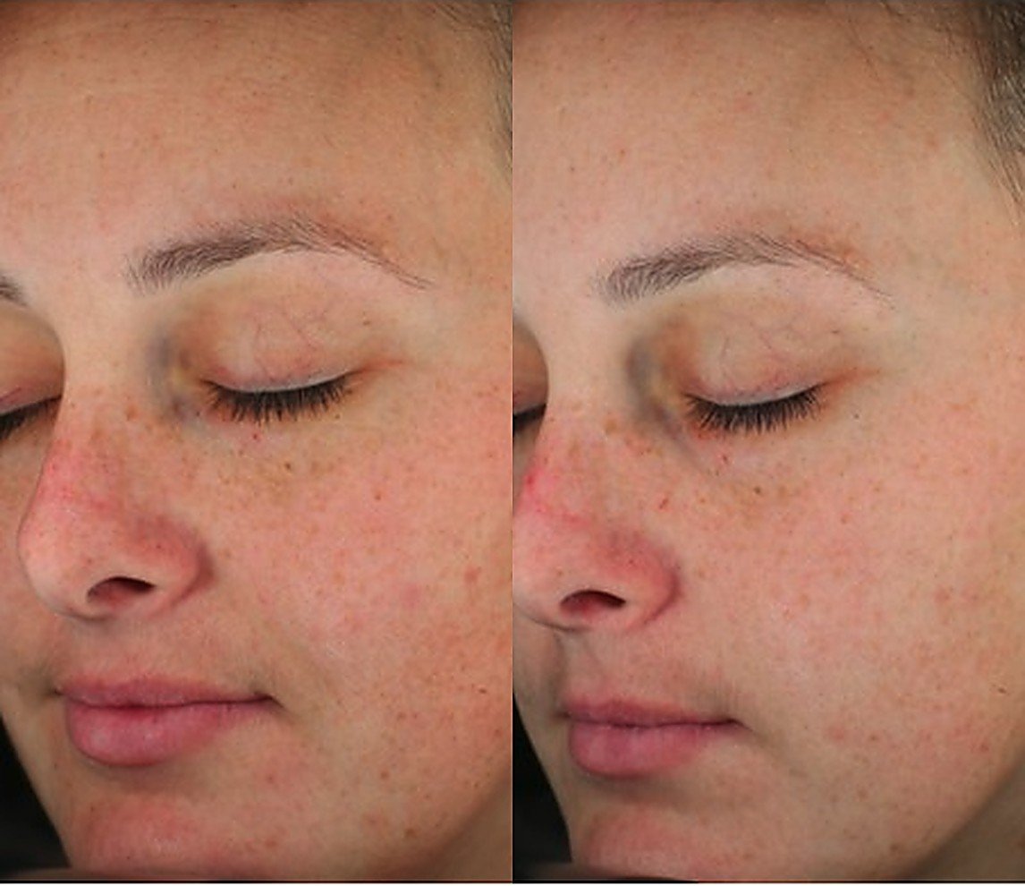 Before and after Glacial Skin for skin tone and redness