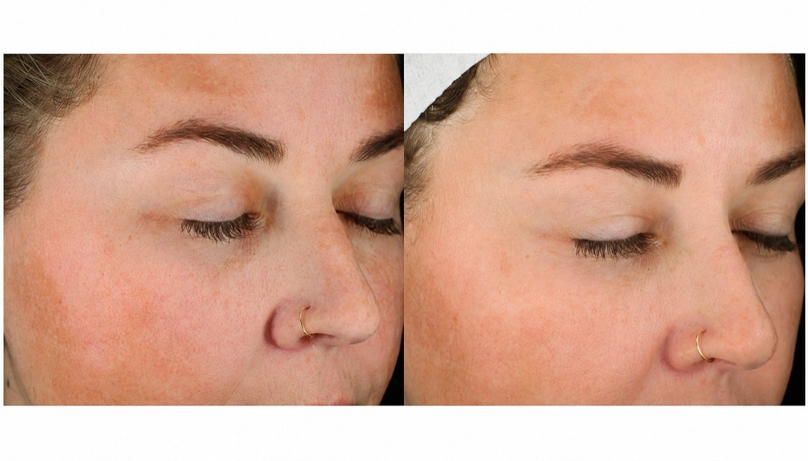 Before and after Glacial Skin for melasma and redness at GetSkin Medical Spa, Hallandale Beach FL