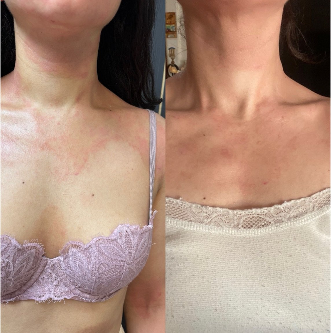 Before and after Glacial Skin for rosacea and redness at GetSkin Medical Spa, Hallandale Beach FL