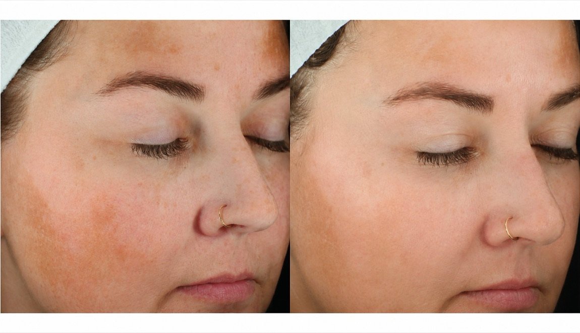 Before and after Glacial Skin for sun spots and pigment at GetSkin Medical Spa, Hallandale Beach FL