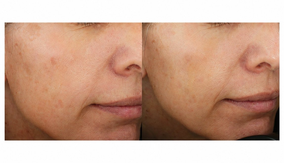 Before and after Glacial Skin for uneven skin tone and spots at GetSkin Medical Spa, Hallandale Beach FL