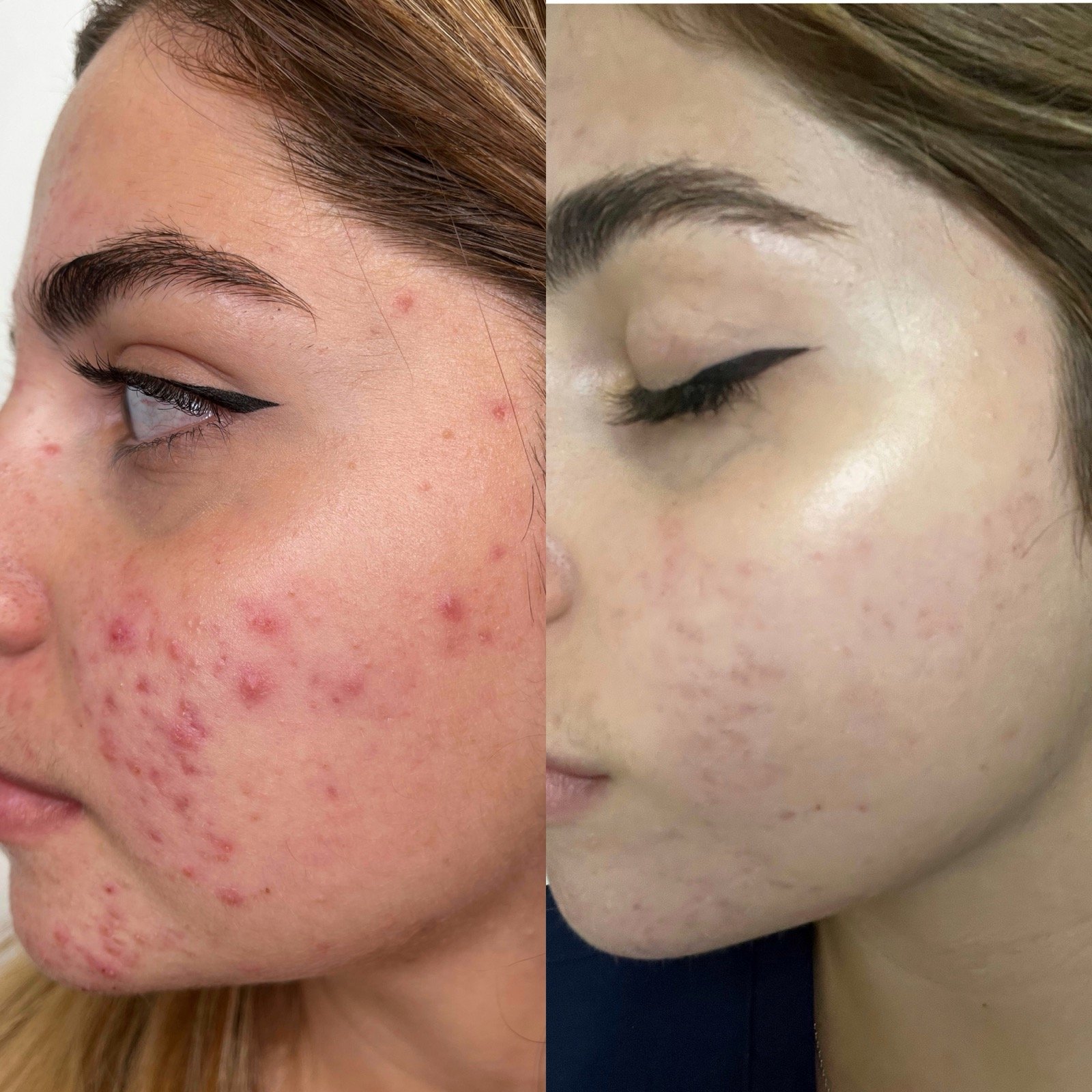 Before and after HydraFacial and chemical peel for acne and scarring at GetSkin Medical Spa, Hallandale Beach FL