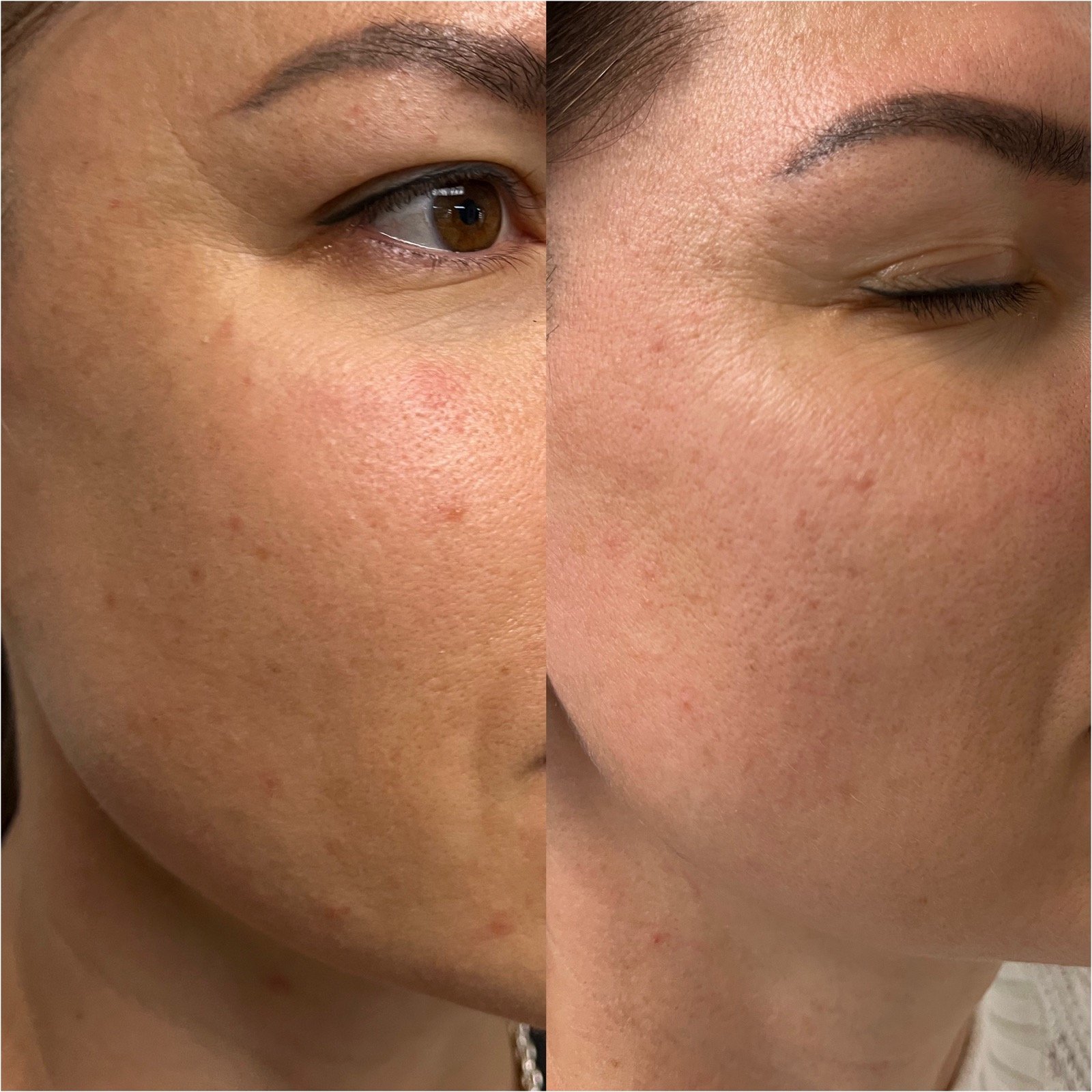 Before and after HydraFacial with extractions for improved skin tone at GetSkin Medical Spa, Hallandale Beach FL