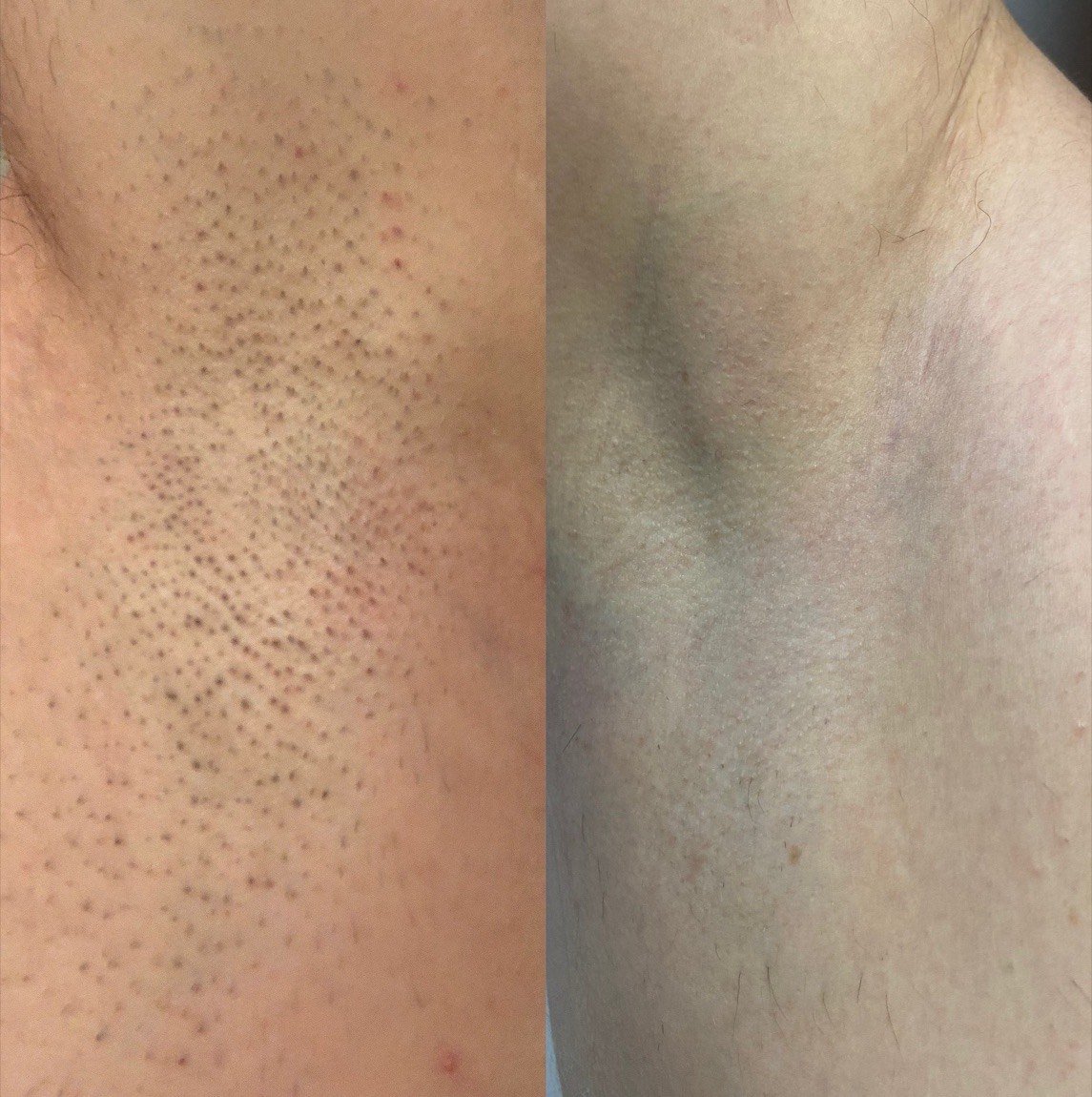Before and after laser hair removal on the underarm at GetSkin Medical Spa, Hallandale Beach FL