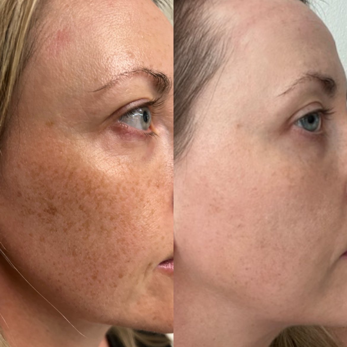 Before and after laser rejuvenation for facial pigmentation at GetSkin Medical Spa, Hallandale Beach FL