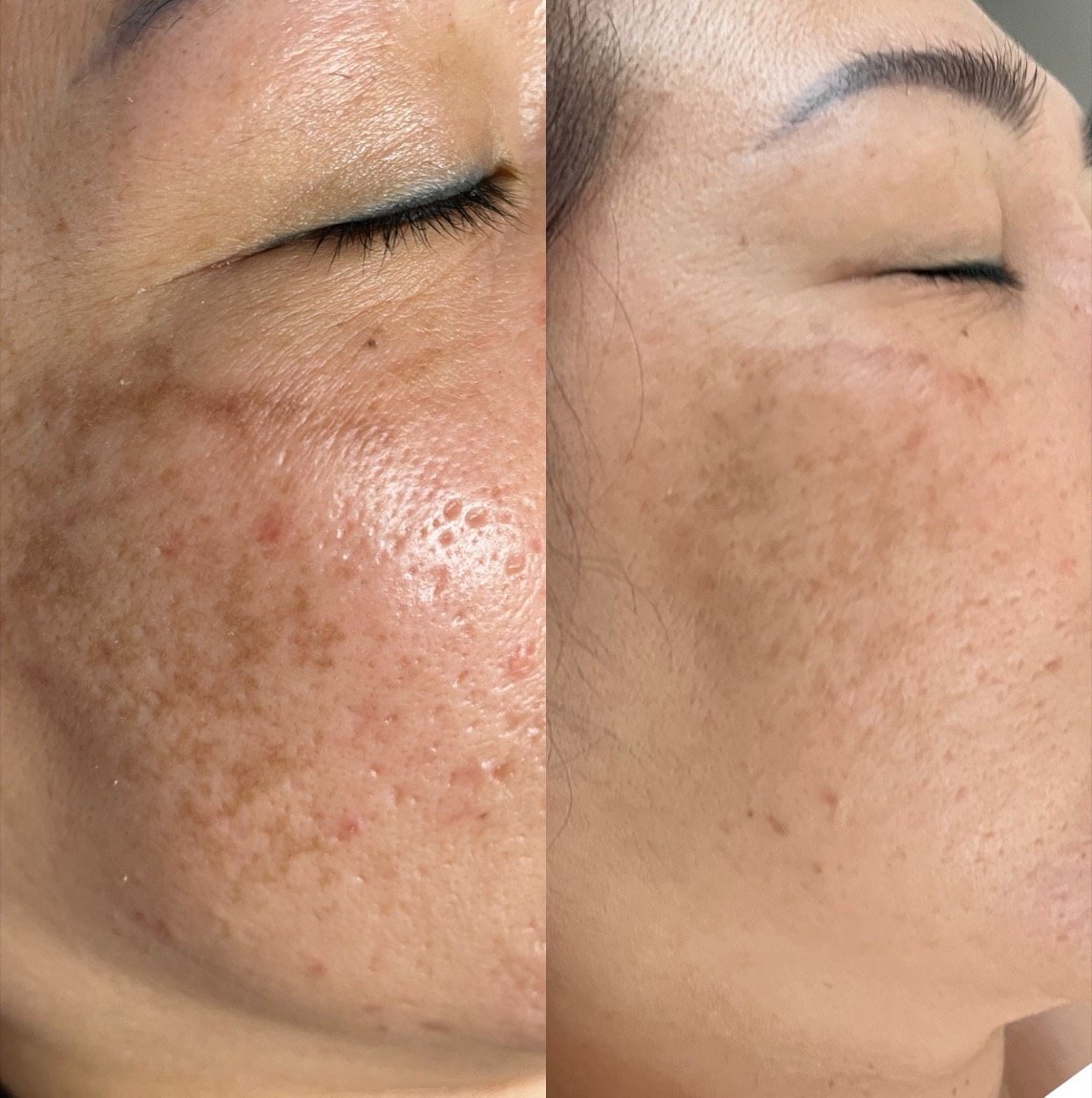 Before and after microneedling for pores and skin texture at GetSkin Medical Spa, Hallandale Beach FL