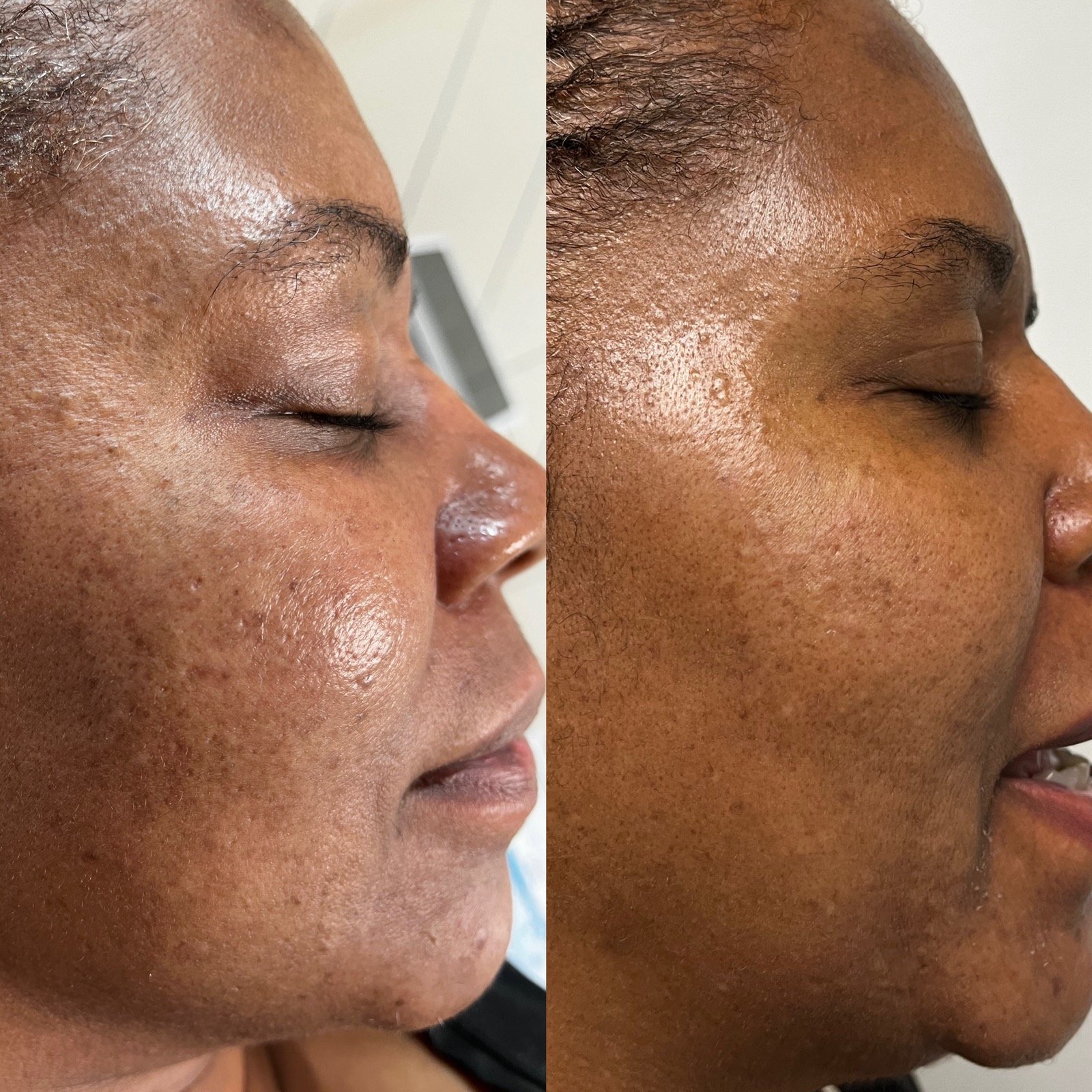Before and after microneedling for tone improvement at GetSkin Medical Spa, Hallandale Beach FL