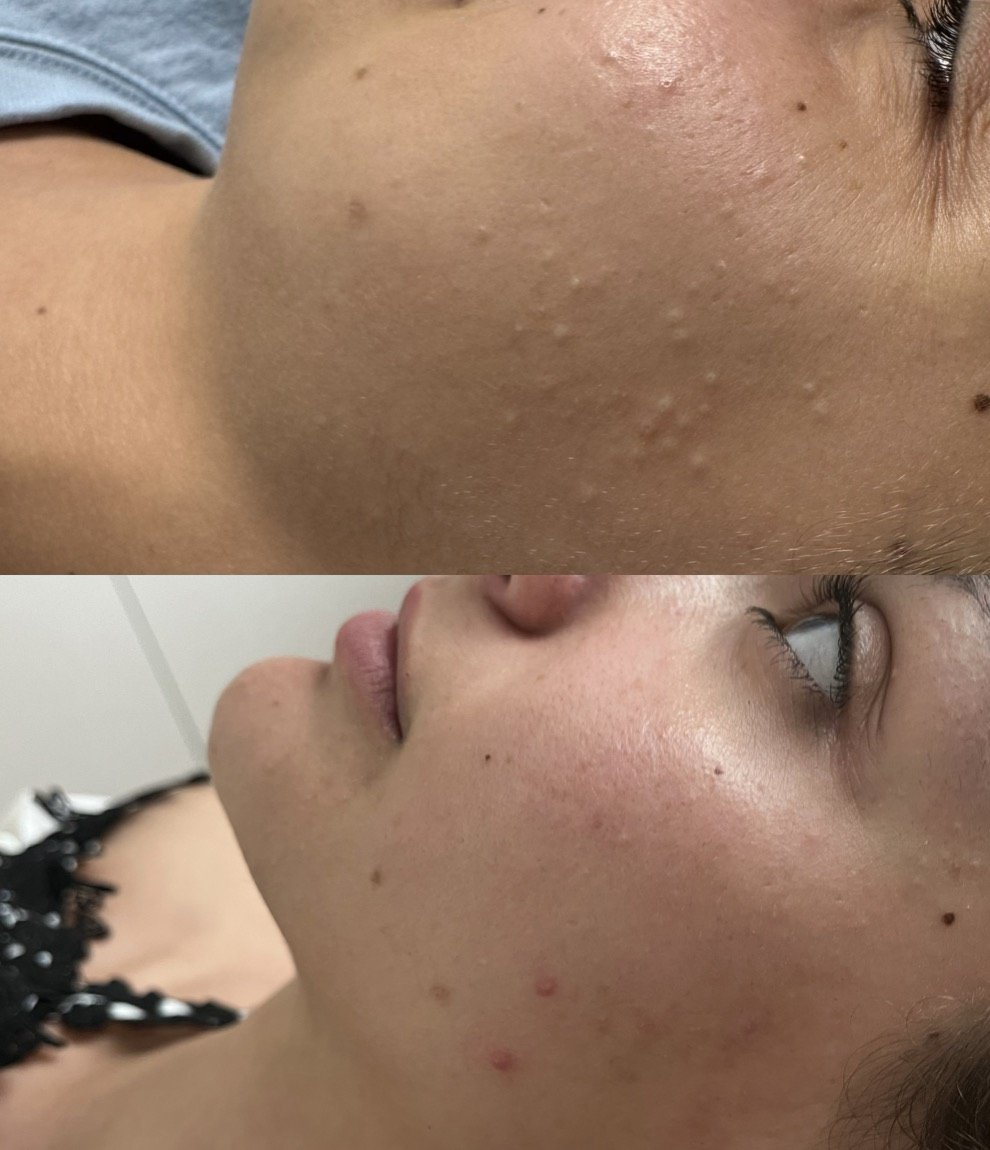 Before and after milia treatment for congestion at GetSkin Medical Spa, Hallandale Beach FL