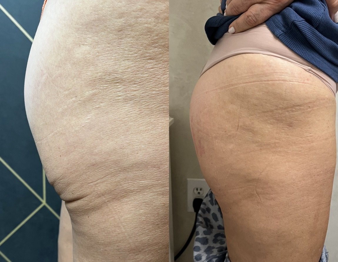 Before and after Morpheus8 Body for cellulite and skin texture at GetSkin Medical Spa, Hallandale Beach FL