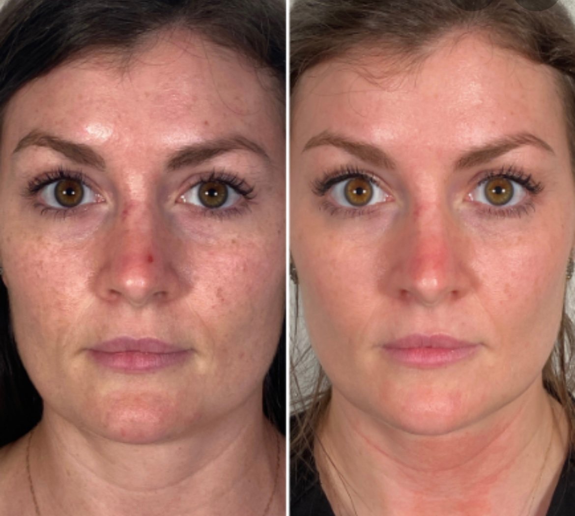 Before and after Morpheus8 for skin tightening and texture at GetSkin Medical Spa, Hallandale Beach FL