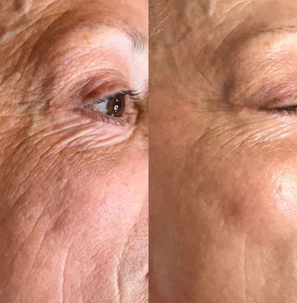 Before and after multi-treatment skin rejuvenation plan at GetSkin Medical Spa, Hallandale Beach FL