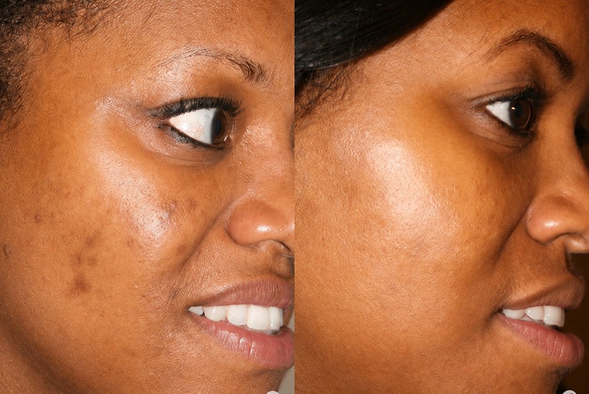 Before and after Perfect Derma Peel for acne and hyperpigmentation at GetSkin Medical Spa, Hallandale Beach FL
