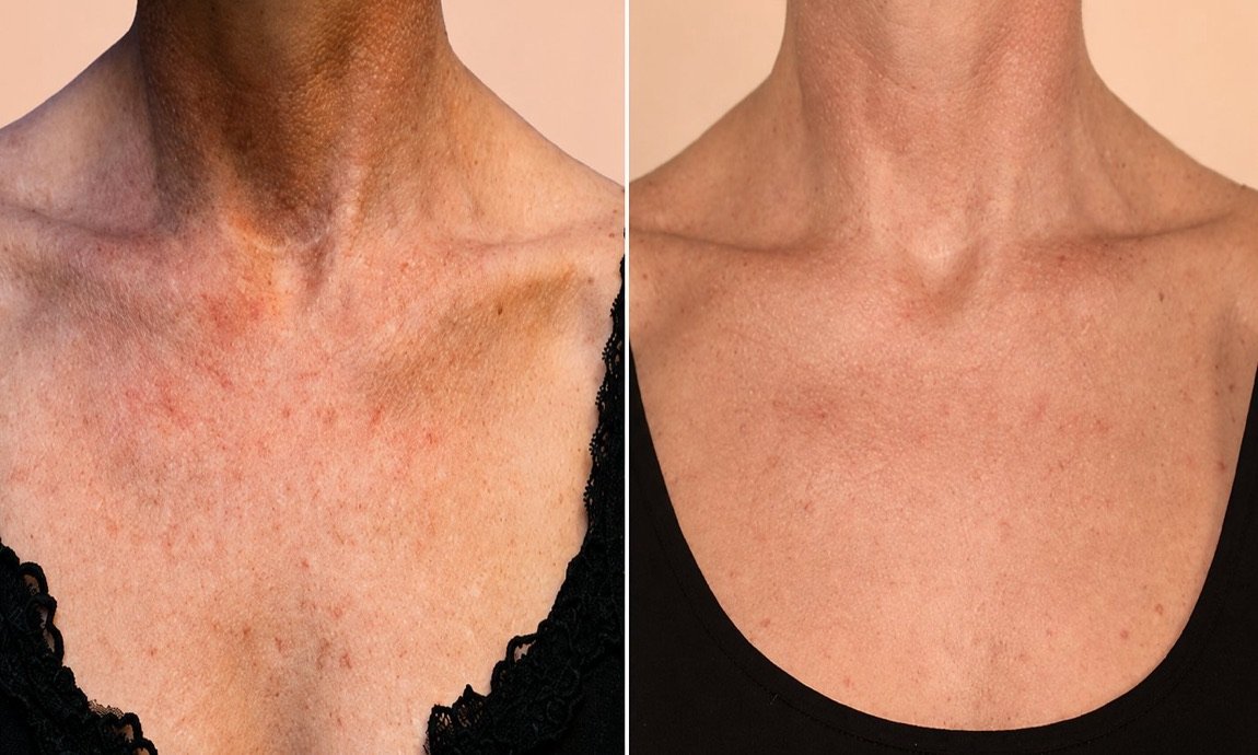 Before and after Perfect Derma Peel for chest and decollete pigmentation at GetSkin Medical Spa, Hallandale Beach FL
