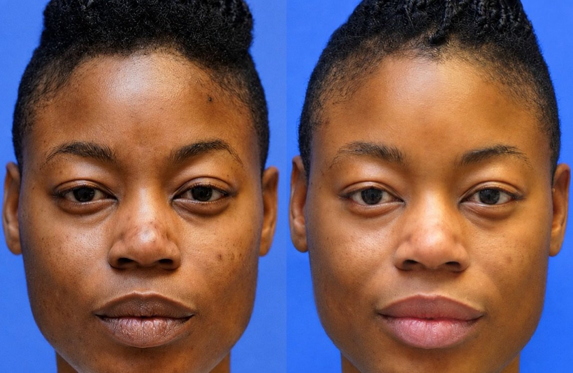 Before and after Perfect Derma Peel for even skin tone at GetSkin Medical Spa, Hallandale Beach FL