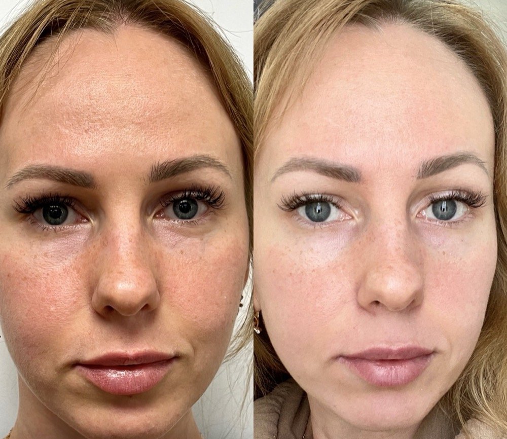 Before and after photofacial for facial redness and tone at GetSkin Medical Spa, Hallandale Beach FL