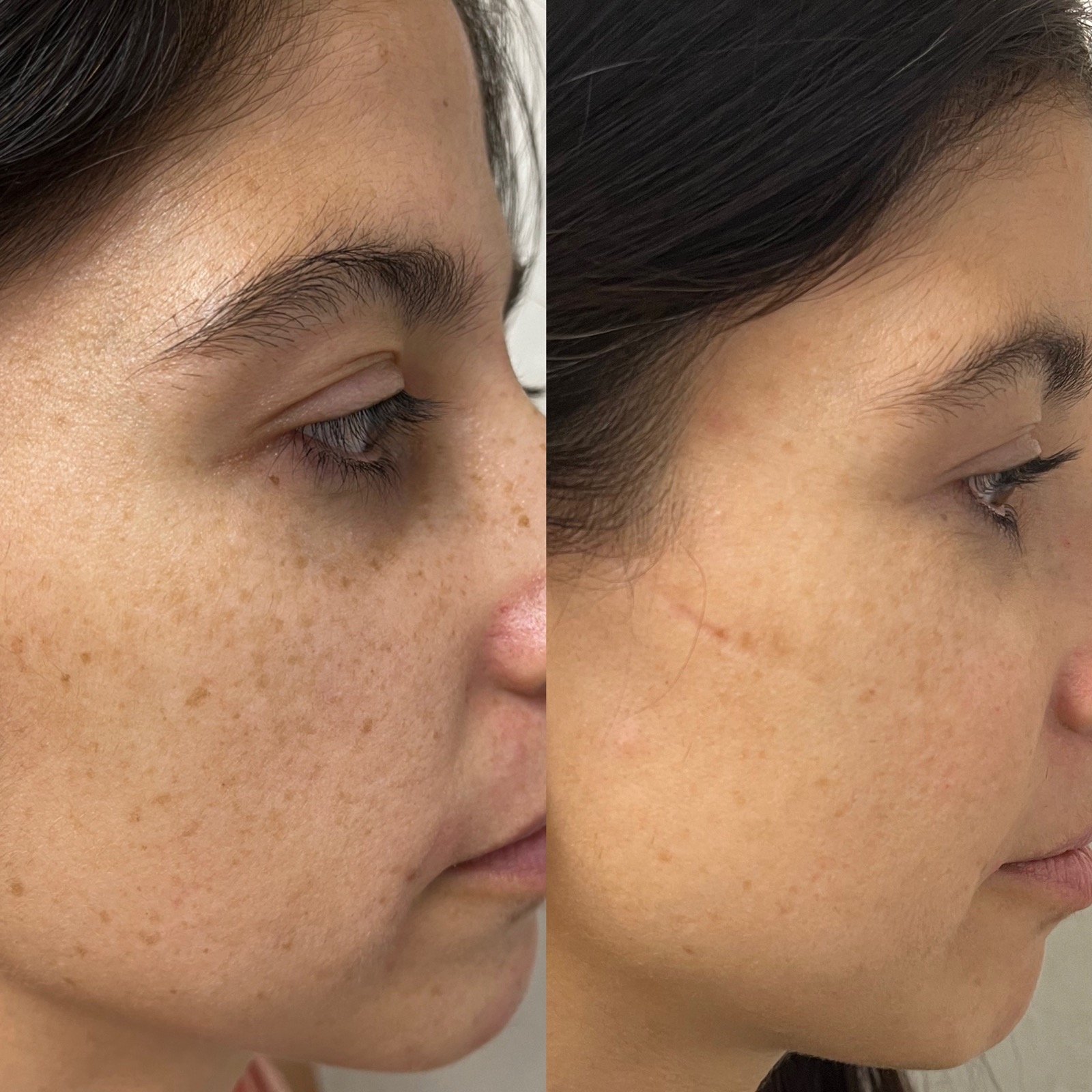 Before and after photofacial for pigment removal at GetSkin Medical Spa, Hallandale Beach FL