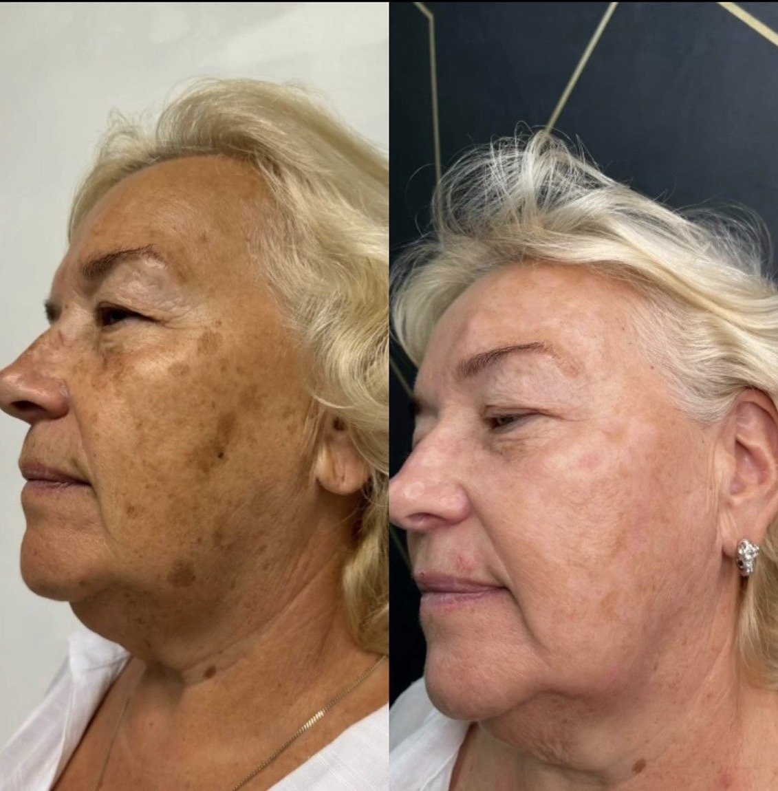 Before and after photofacial for pigmentation and sun damage at GetSkin Medical Spa, Hallandale Beach FL