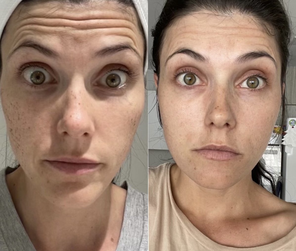 Before and after photofacial for sun damage and collagen building at GetSkin Medical Spa, Hallandale Beach FL