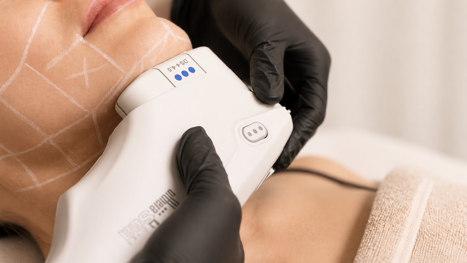 Ultherapy treatment