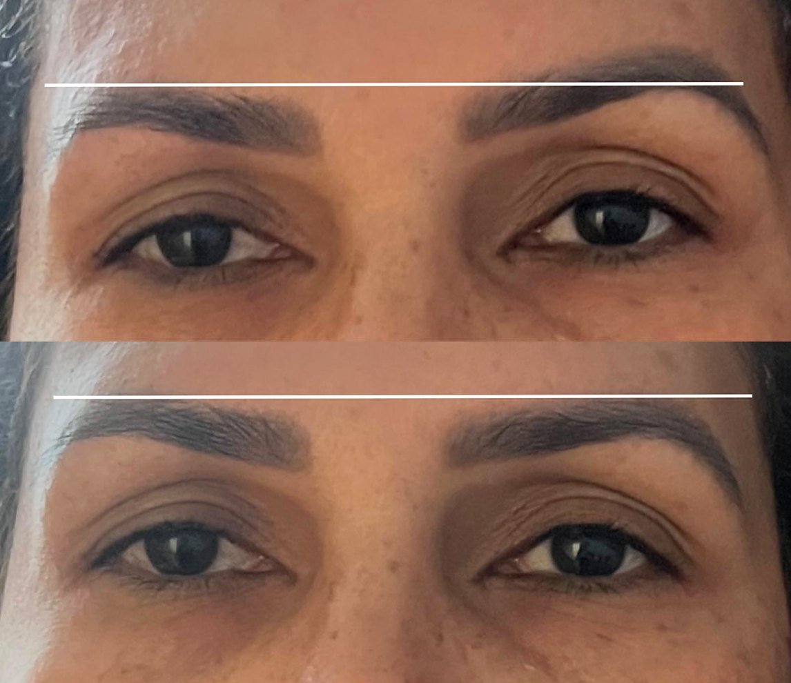 Before and after Ultherapy for non-surgical brow lift at GetSkin Medical Spa, Hallandale Beach FL