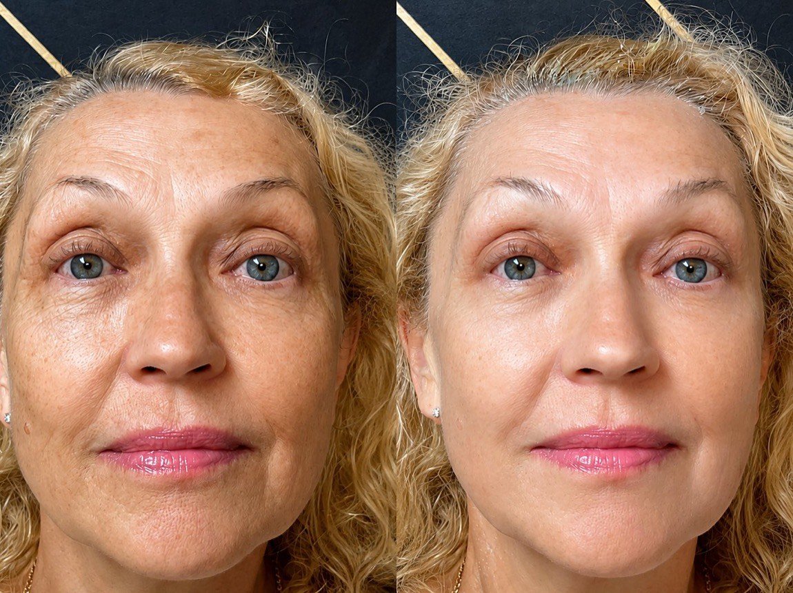 Before and after Ultherapy for facial lifting and firmness at GetSkin Medical Spa, Hallandale Beach FL