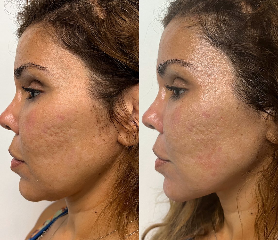 Before and after Ultherapy for jawline contouring at GetSkin Medical Spa, Hallandale Beach FL