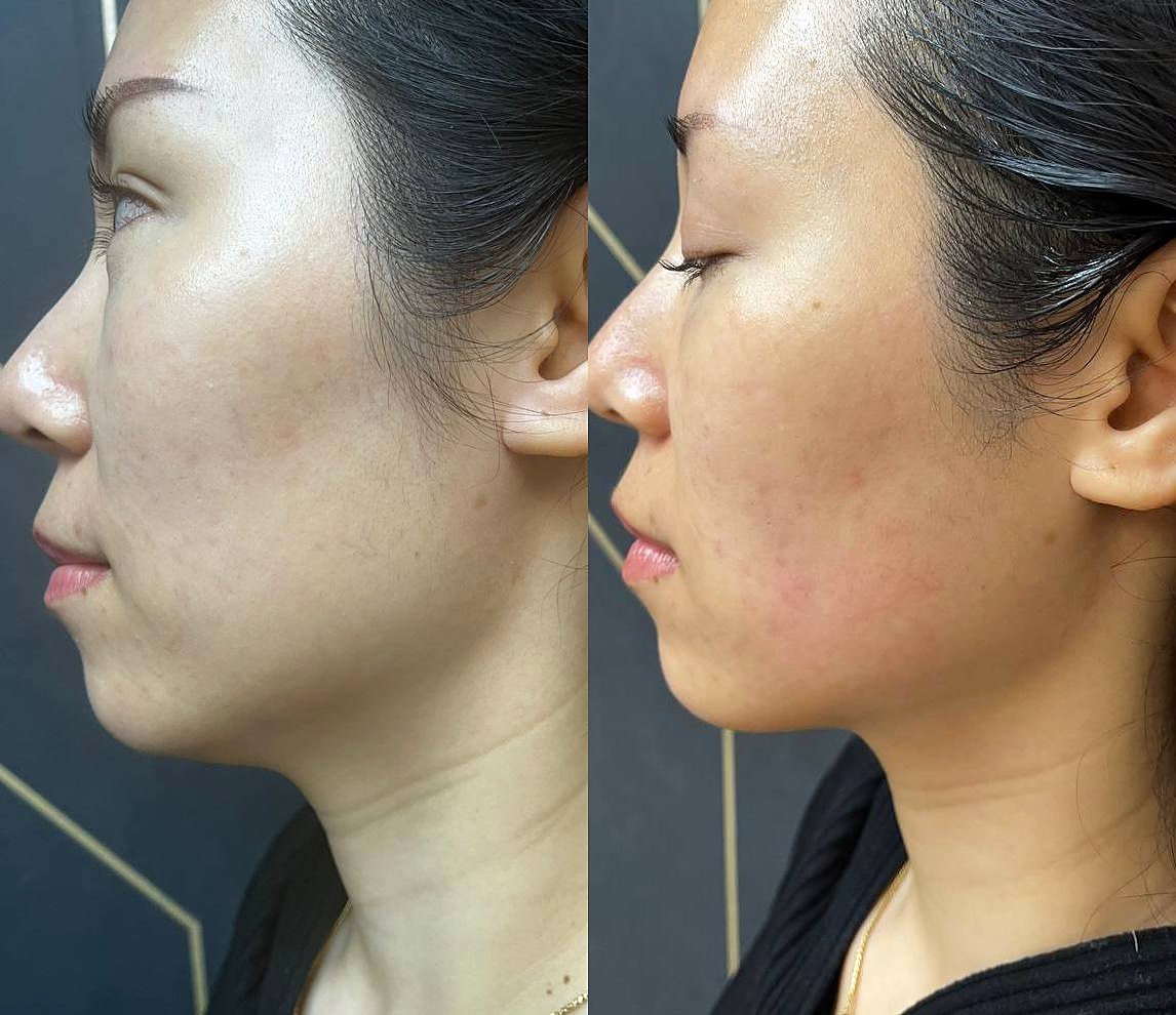 Before and after Ultherapy for jawline definition at GetSkin Medical Spa, Hallandale Beach FL