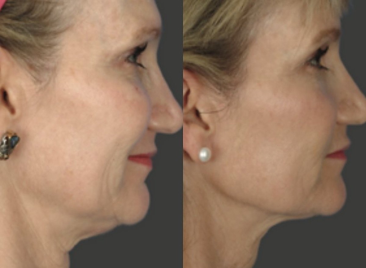 Before and after Ultherapy for jawline and neck lifting at GetSkin Medical Spa, Hallandale Beach FL