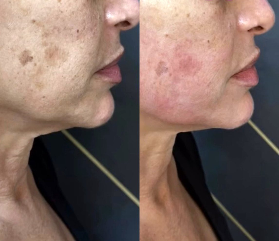 Before and after Ultherapy for jawline and neck tightening at GetSkin Medical Spa, Hallandale Beach FL