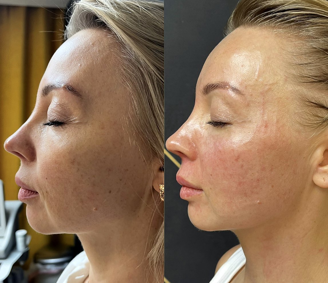 Before and after Ultherapy for lower face lifting at GetSkin Medical Spa, Hallandale Beach FL
