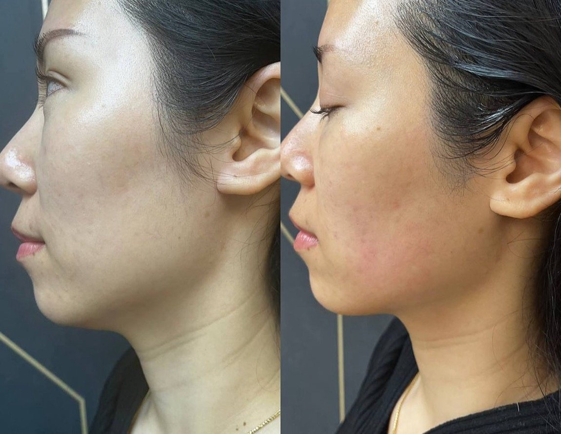 Before and after Ultherapy for neck and jawline, shown immediately post-treatment, at GetSkin Medical Spa, Hallandale Beach FL